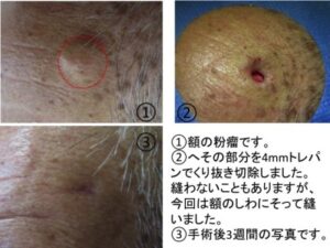 粉瘤（アテローム、表皮嚢腫）のくりぬき法 - 日高クリニック